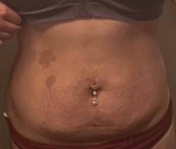 Before treatment image